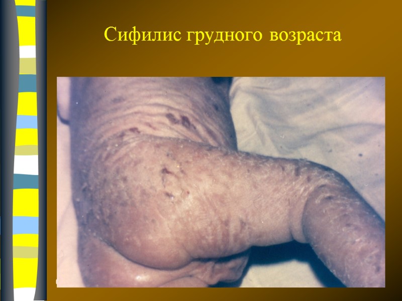 09.12.2017 Сифилис грудного возраста